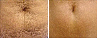 Cryo21 - Raffermissant ventre Cryo21 - Raffermissant ventre